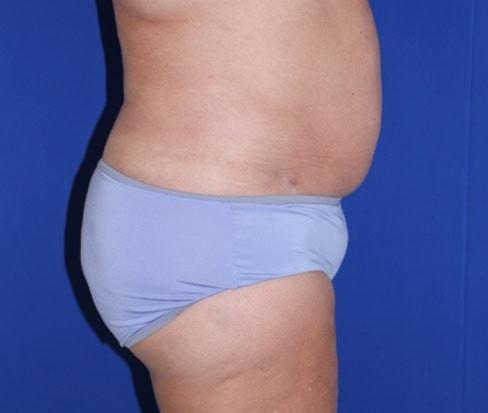 Liposuction before at Iconic Plastic Surgery in Carlsbad, CA