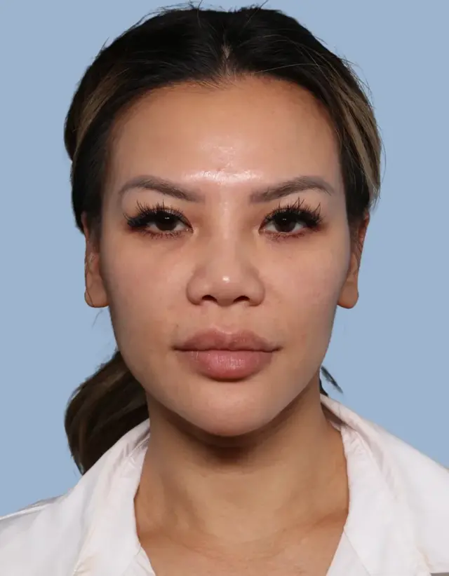 Brow Lift before at Jonathan Zelken MD in Newport Beach, CA