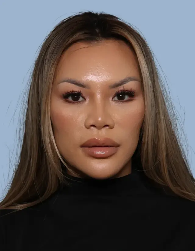 Brow Lift after at Jonathan Zelken MD in Newport Beach, CA