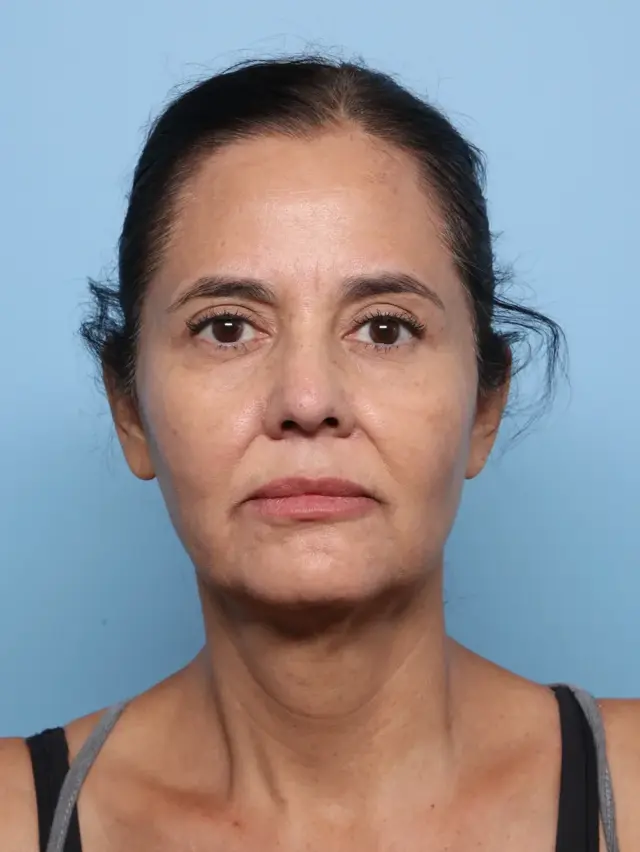 Blepharoplasty after at Jonathan Zelken MD in Newport Beach, CA