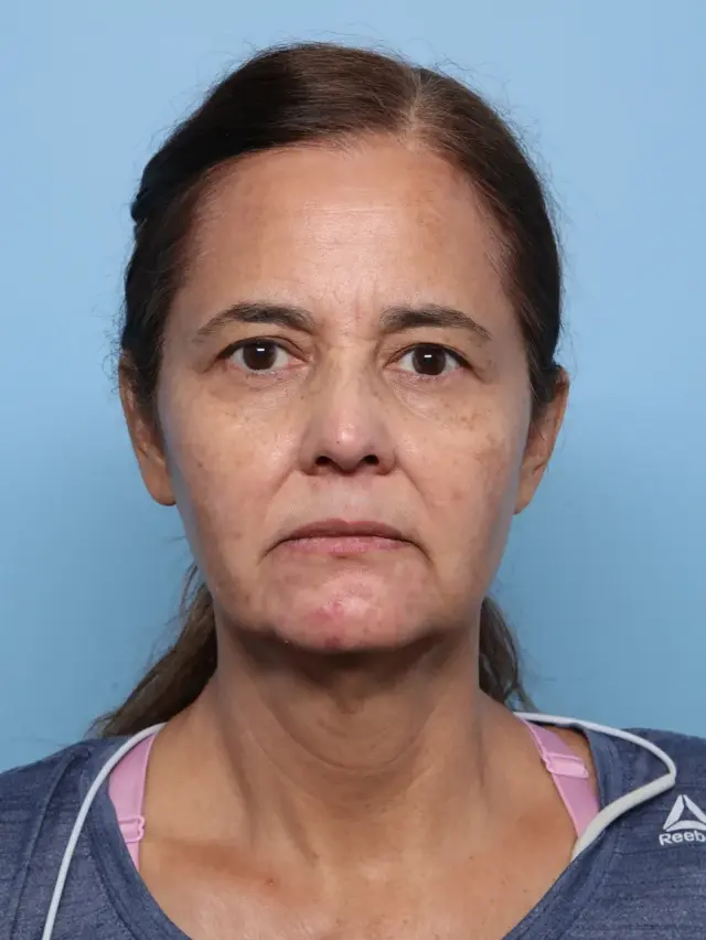 Blepharoplasty before at Jonathan Zelken MD in Newport Beach, CA