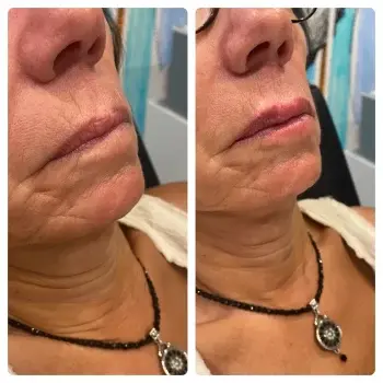 Juvederm result at Hydrate Me Medspa - Grandview in Columbus, OH