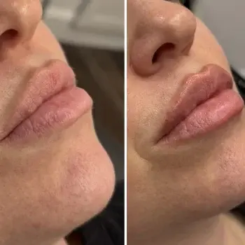 Lip Filler result at Hydrate Me Medspa - Grandview in Columbus, OH