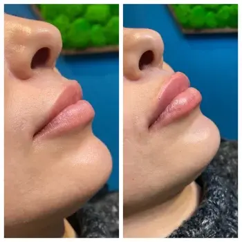 Lip Filler result at Hydrate Me Medspa - Grandview in Columbus, OH