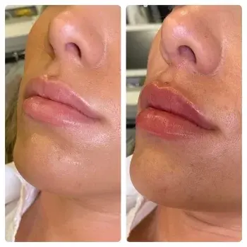 Lip Filler result at Hydrate Me Medspa - Grandview in Columbus, OH