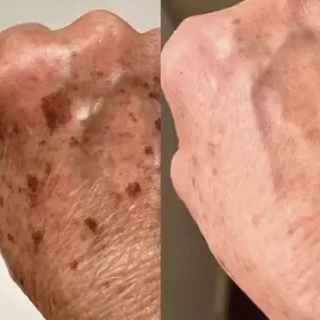 Hydrate Me Medspa - Grandview result — Columbus, OH