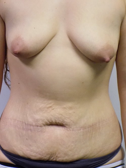 Mini Tummy Tuck before at Bellissimo Plastic Surgery & Medi Spa in Pittsburgh, PA