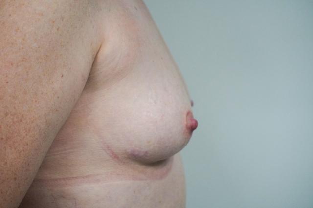 Breast Augmentation before at Bellissimo Plastic Surgery & Medi Spa in Pittsburgh, PA