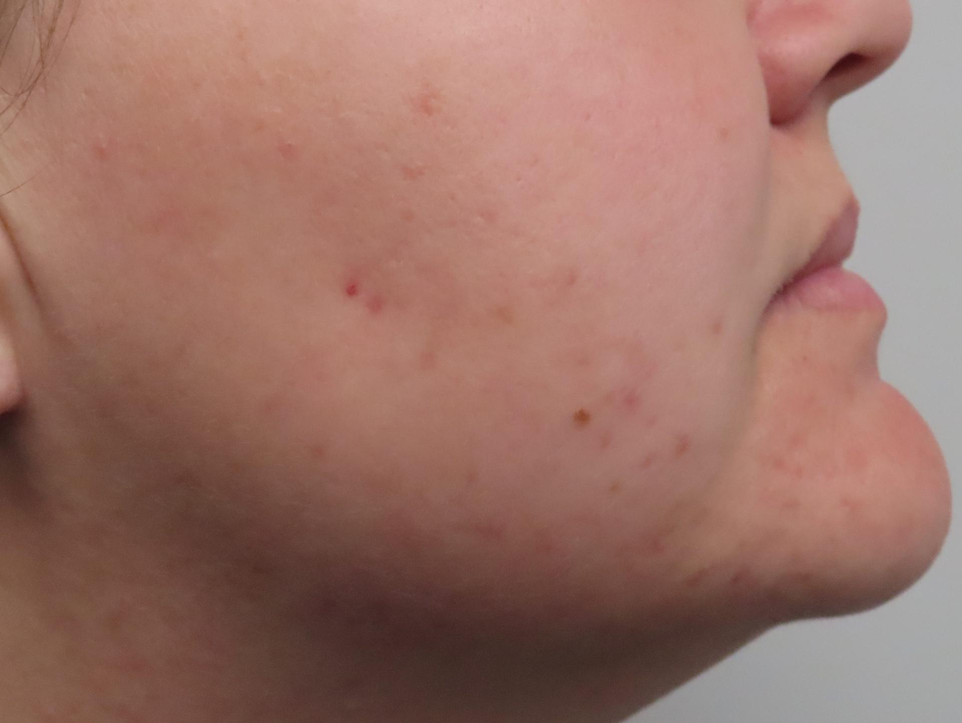 Bellissimo Plastic Surgery & Medi Spa laser treatment after — Pittsburgh, PA