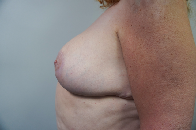 Breast Reduction after at Bellissimo Plastic Surgery & Medi Spa in Pittsburgh, PA