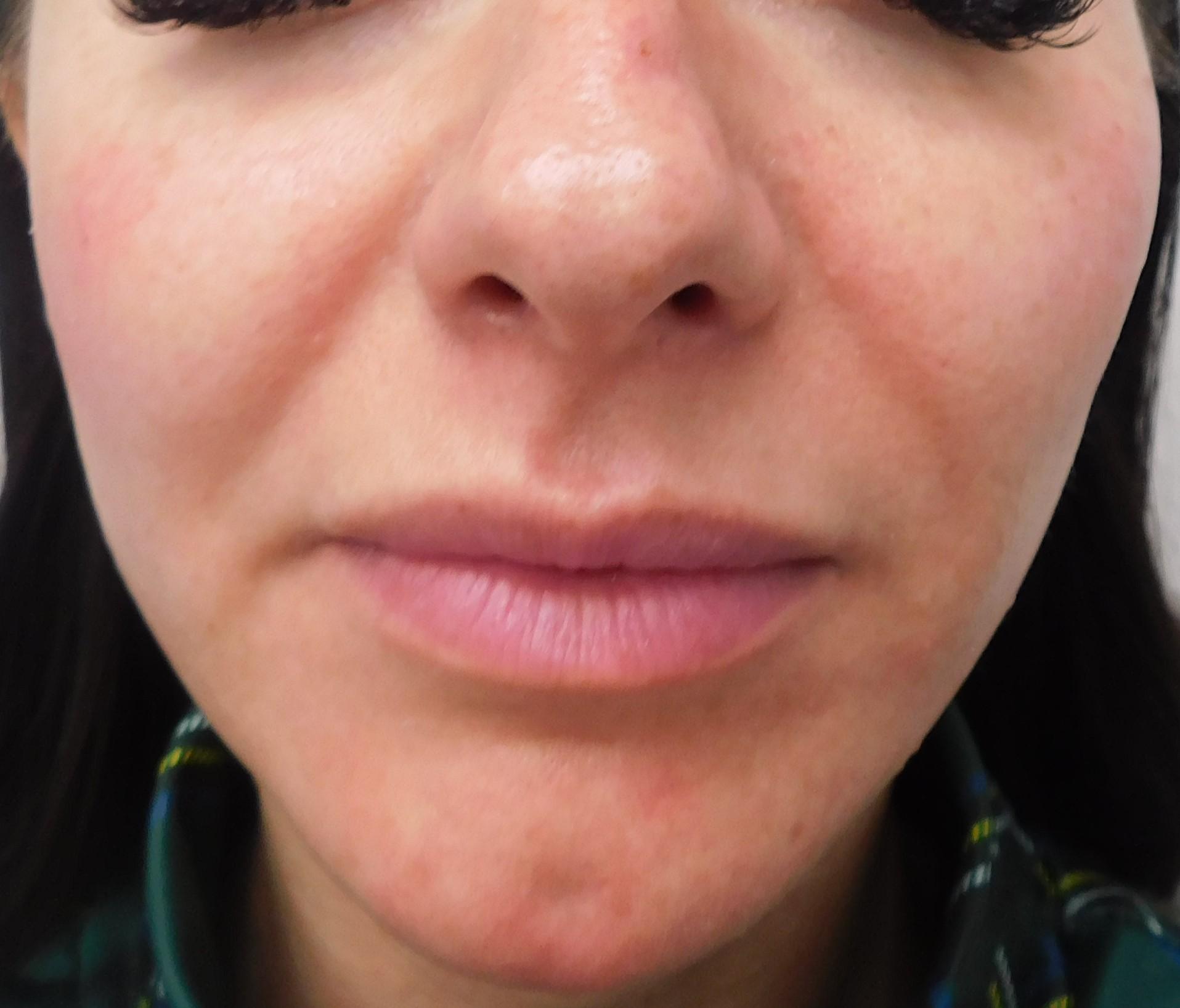 Bellissimo Plastic Surgery & Medi Spa after — Pittsburgh, PA