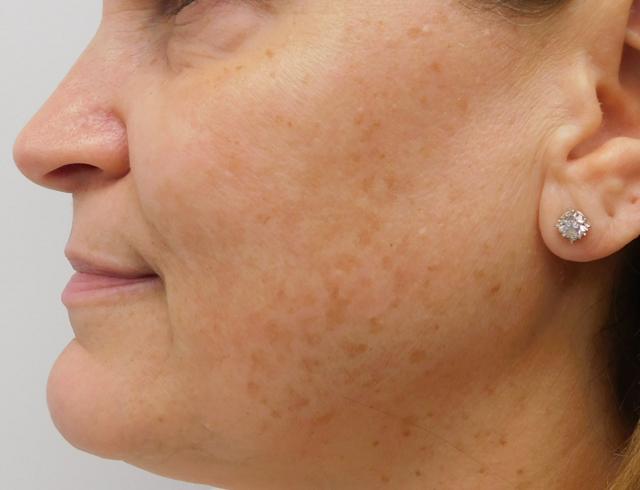 Laser Skin Resurfacing before at Bellissimo Plastic Surgery & Medi Spa in Pittsburgh, PA