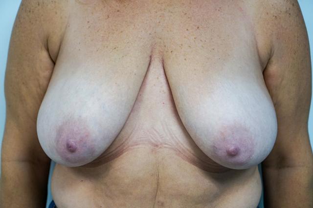 Breast Lift before at Bellissimo Plastic Surgery & Medi Spa in Pittsburgh, PA