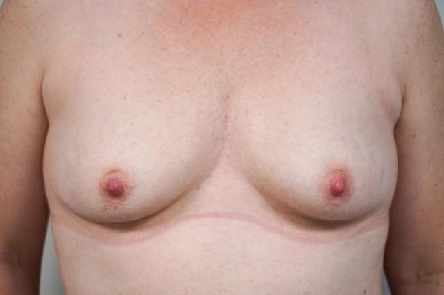 Breast Augmentation before at Bellissimo Plastic Surgery & Medi Spa in Pittsburgh, PA