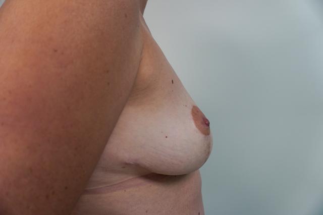 Breast Lift after at Bellissimo Plastic Surgery & Medi Spa in Pittsburgh, PA