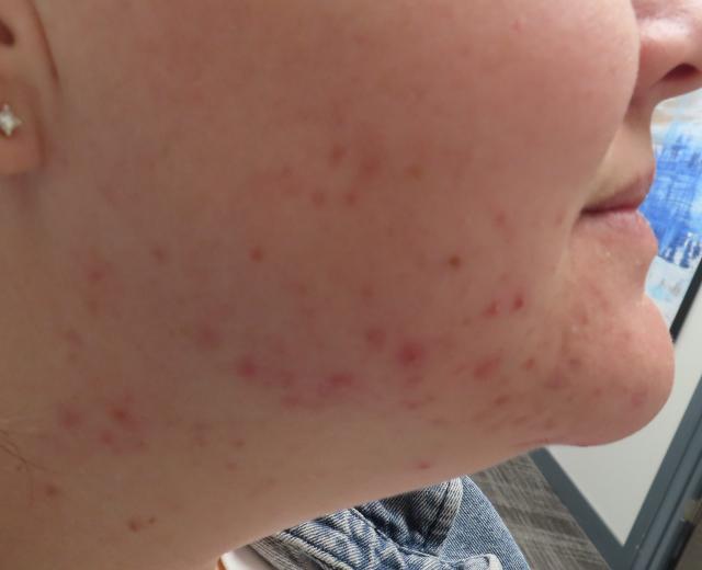 Laser Skin Resurfacing before at Bellissimo Plastic Surgery & Medi Spa in Pittsburgh, PA