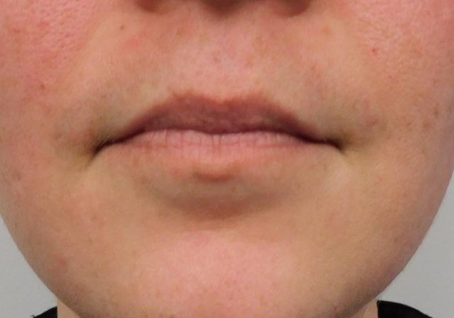 Juvederm before at Bellissimo Plastic Surgery & Medi Spa in Pittsburgh, PA