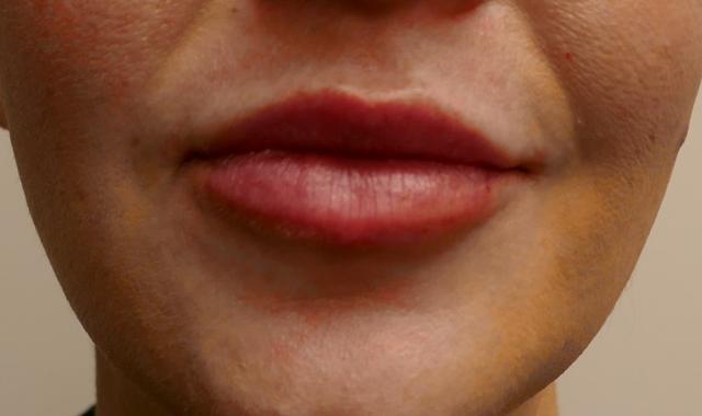 Juvederm after at Bellissimo Plastic Surgery & Medi Spa in Pittsburgh, PA
