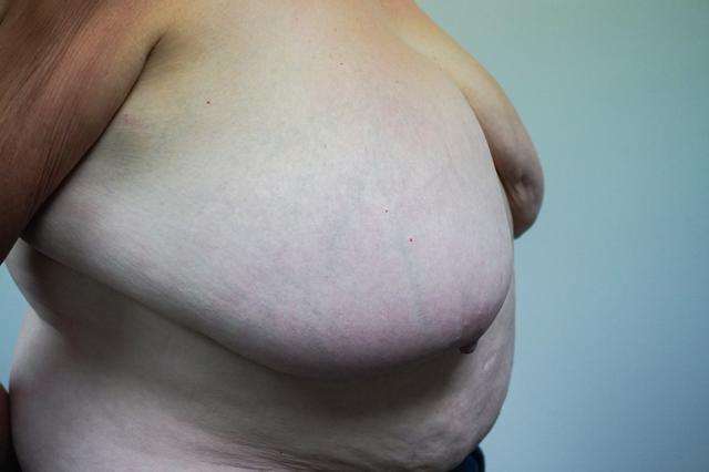 Breast Reduction before at Bellissimo Plastic Surgery & Medi Spa in Pittsburgh, PA