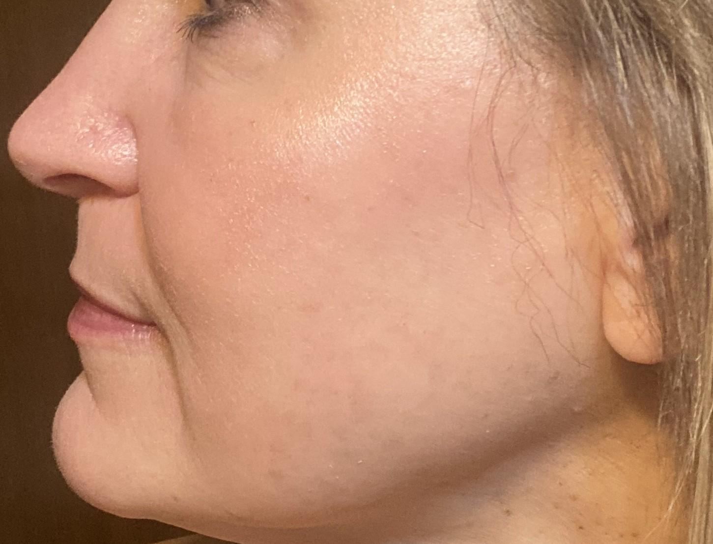 Bellissimo Plastic Surgery & Medi Spa laser treatment after — Pittsburgh, PA