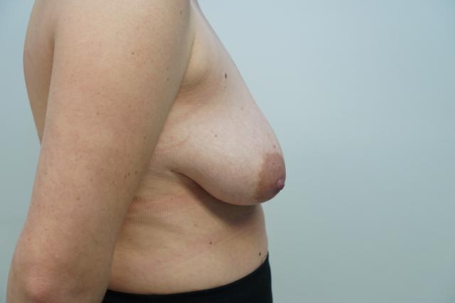 Breast Lift before at Bellissimo Plastic Surgery & Medi Spa in Pittsburgh, PA