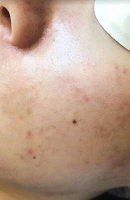 Laser Skin Resurfacing after at Bellissimo Plastic Surgery & Medi Spa in Pittsburgh, PA