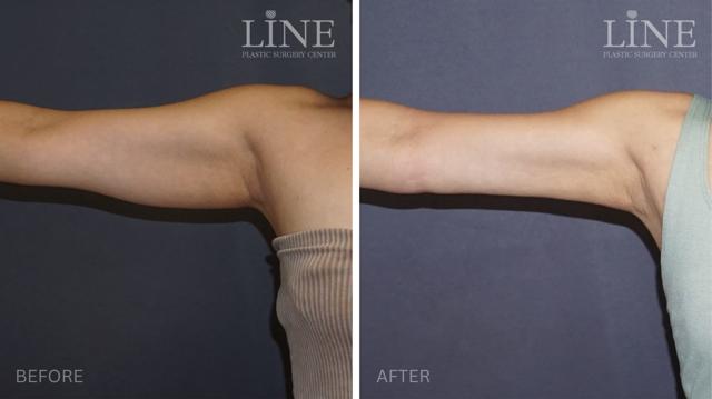 Liposuction result at Line Plastic Surgery Irvine in Irvine, CA