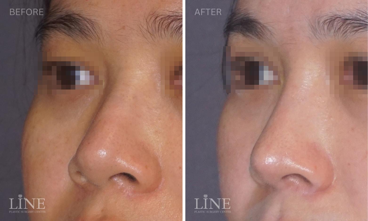 Line Plastic Surgery Irvine rhinoplasty result — Irvine, CA
