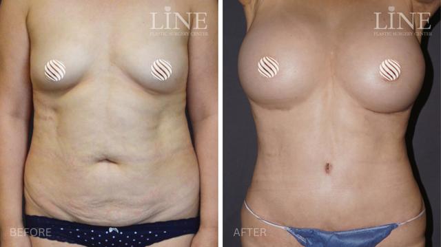 Mommy Makeover result at Line Plastic Surgery Irvine in Irvine, CA