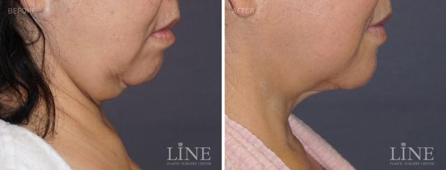 Neck Liposuction result at Line Plastic Surgery Irvine in Irvine, CA