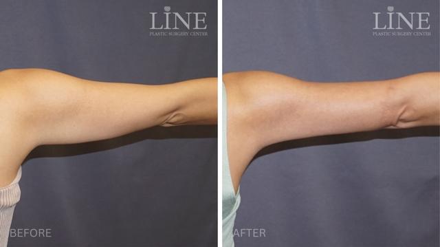 Liposuction result at Line Plastic Surgery Irvine in Irvine, CA