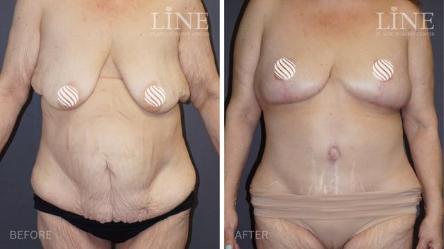 Mommy Makeover result at Line Plastic Surgery Irvine in Irvine, CA