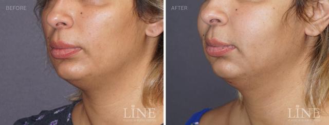 Fat Transfer result at Line Plastic Surgery Irvine in Irvine, CA
