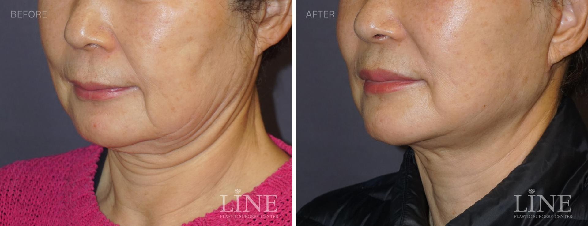 Line Plastic Surgery Irvine fat transfer result — Irvine, CA