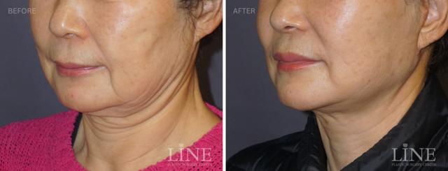 Fat Transfer result at Line Plastic Surgery Irvine in Irvine, CA
