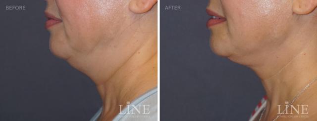 Neck Liposuction result at Line Plastic Surgery Irvine in Irvine, CA