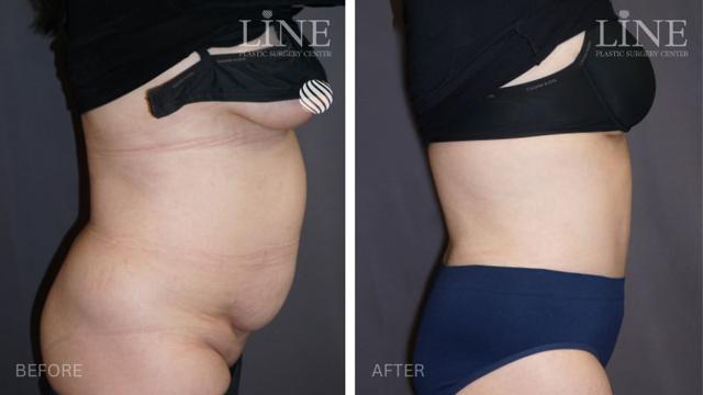 Tummy Tuck result at Line Plastic Surgery Irvine in Irvine, CA