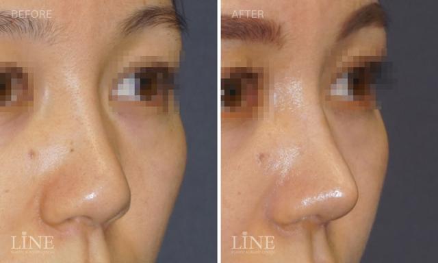 Rhinoplasty result at Line Plastic Surgery Irvine in Irvine, CA