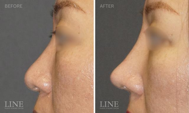 Rhinoplasty result at Line Plastic Surgery Irvine in Irvine, CA