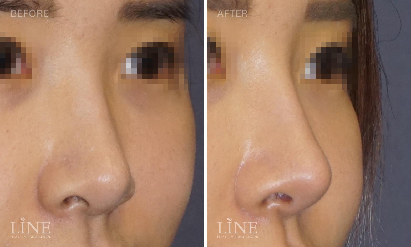 Line Plastic Surgery Irvine rhinoplasty result — Irvine, CA