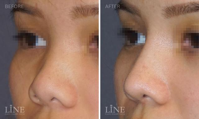 Rhinoplasty result at Line Plastic Surgery Irvine in Irvine, CA