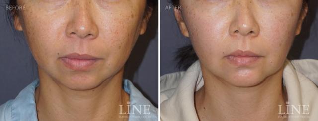 Fat Transfer result at Line Plastic Surgery Irvine in Irvine, CA