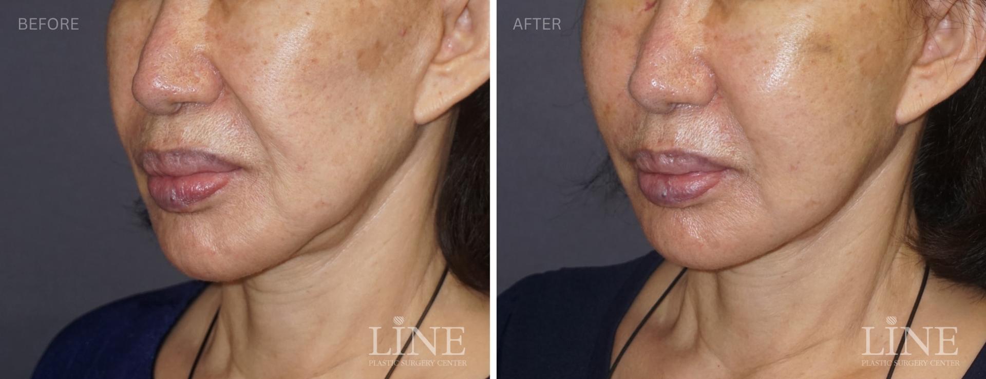 Line Plastic Surgery Irvine fat transfer result — Irvine, CA