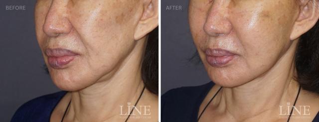 Fat Transfer result at Line Plastic Surgery Irvine in Irvine, CA
