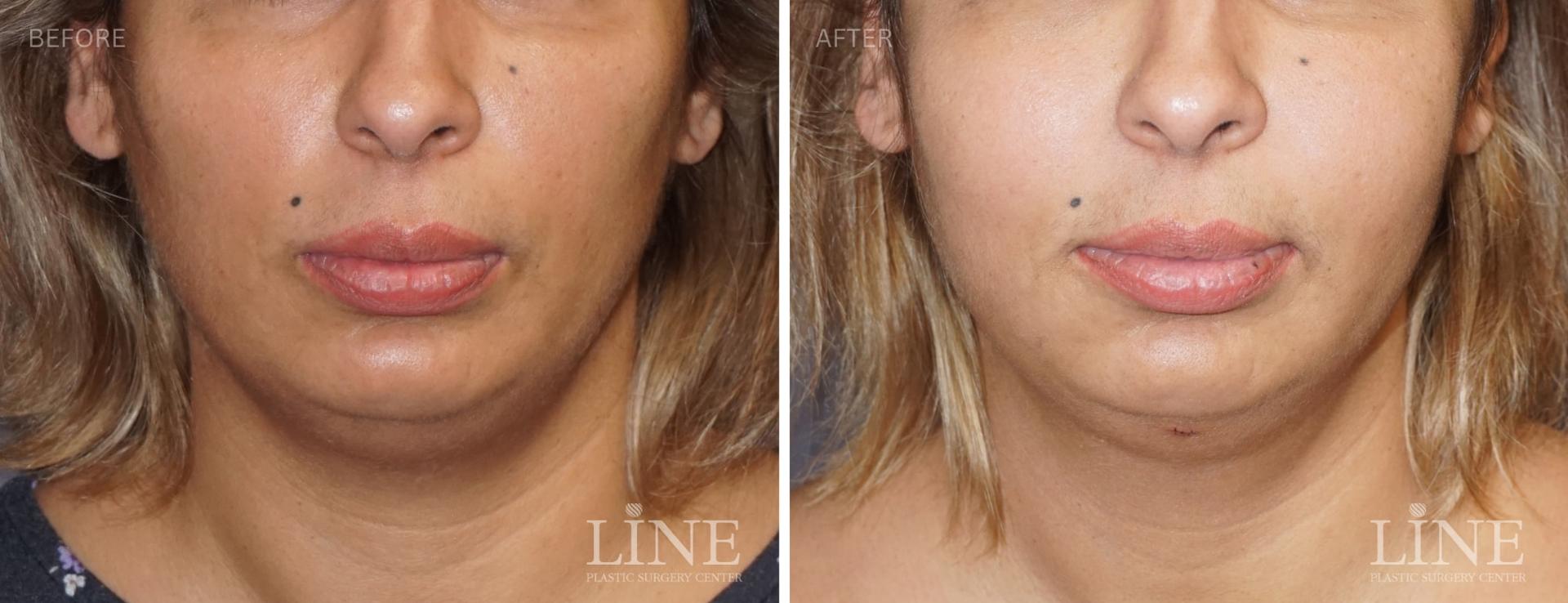 Line Plastic Surgery Irvine fat transfer result — Irvine, CA