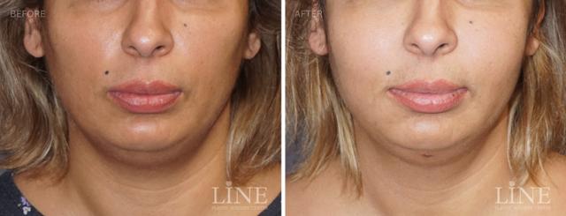 Fat Transfer result at Line Plastic Surgery Irvine in Irvine, CA