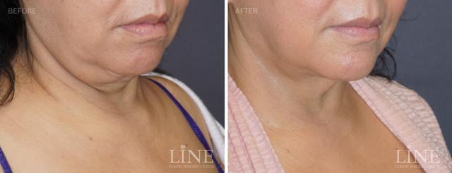 Neck Liposuction result at Line Plastic Surgery Irvine in Irvine, CA