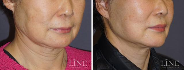 Fat Transfer result at Line Plastic Surgery Irvine in Irvine, CA