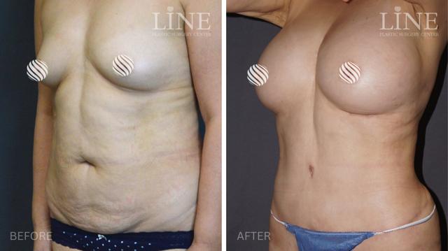 Mommy Makeover result at Line Plastic Surgery Irvine in Irvine, CA
