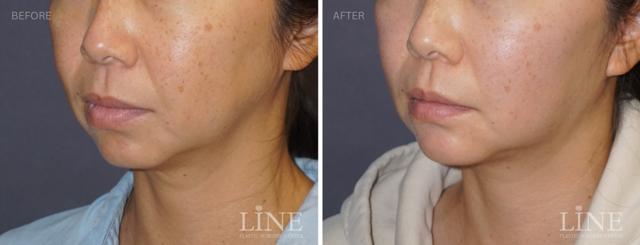 Fat Transfer result at Line Plastic Surgery Irvine in Irvine, CA